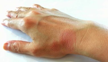 Vírus comum pode ser a chave do lúpus, dizem cientistas