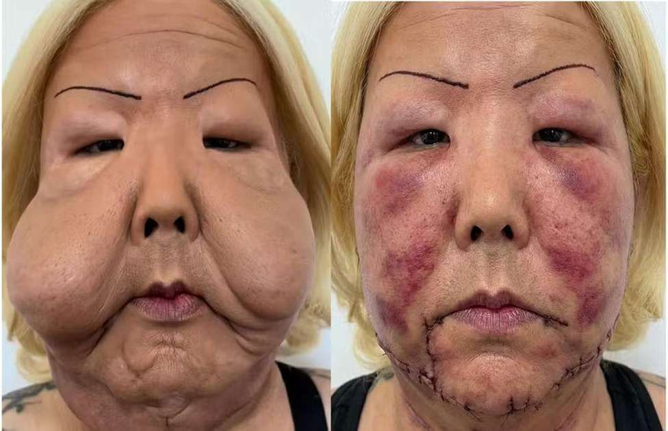 Juju do Pix passa por cirurgia para retirar óleo mineral do rosto