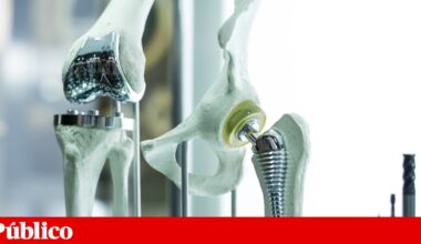 Ossos “à medida” vão ser possíveis com implantes criados com IA e impressão 3D | Saúde
