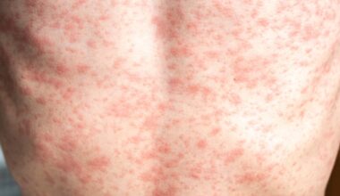 Sarampo: Brasil soma 37 casos neste ano e reforça vacinação em meio à alta no continente e à COP-30