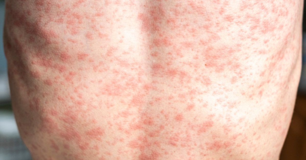 Sarampo: Brasil soma 37 casos neste ano e reforça vacinação em meio à alta no continente e à COP-30