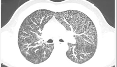Homem contrai tuberculose rara no pênis; entenda o caso!