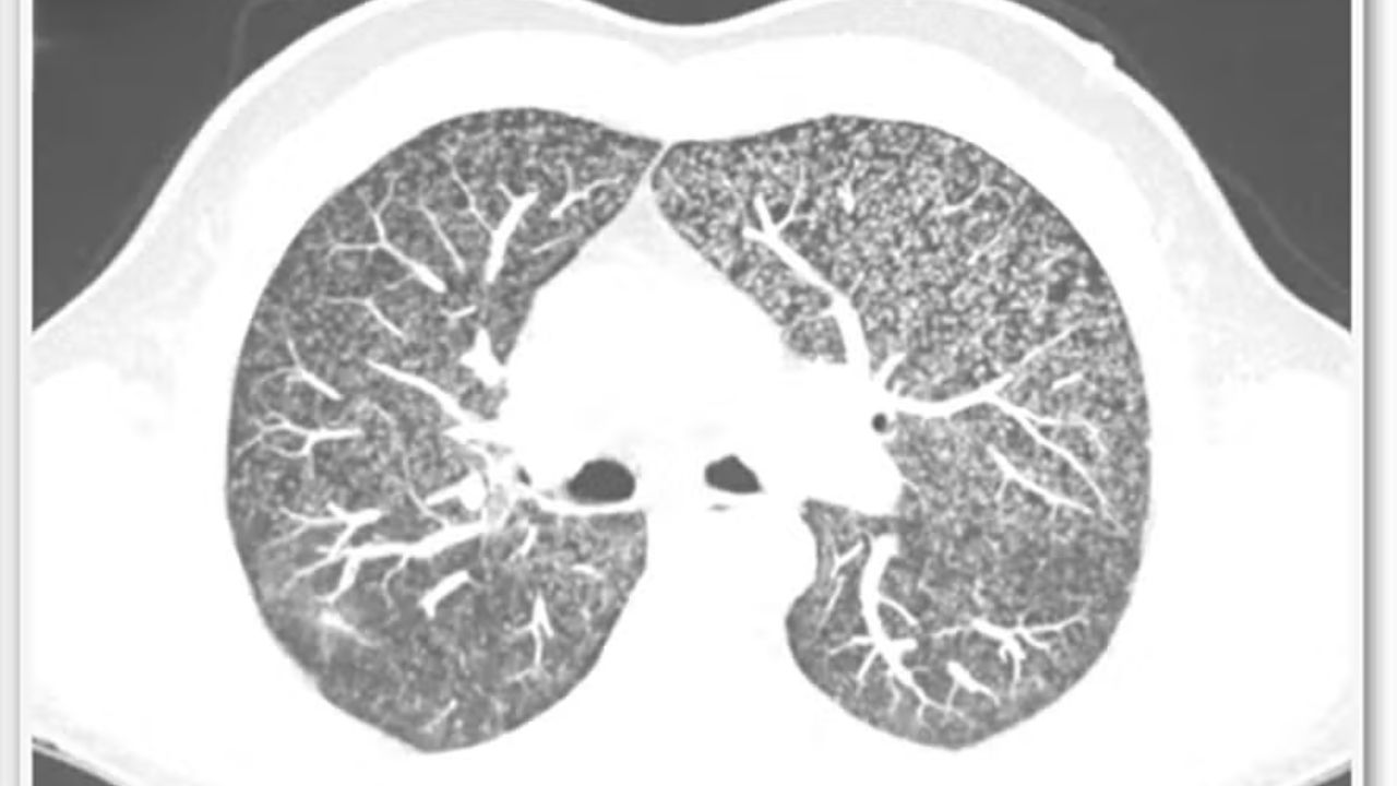 Homem contrai tuberculose rara no pênis; entenda o caso!