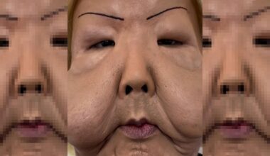 Juju do Pix faz cirurgia após ter rosto deformado em procedimento