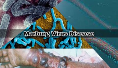 Marburg – Surto de vírus mortal na Etiópia acende alerta no mundo todo - Juranda News