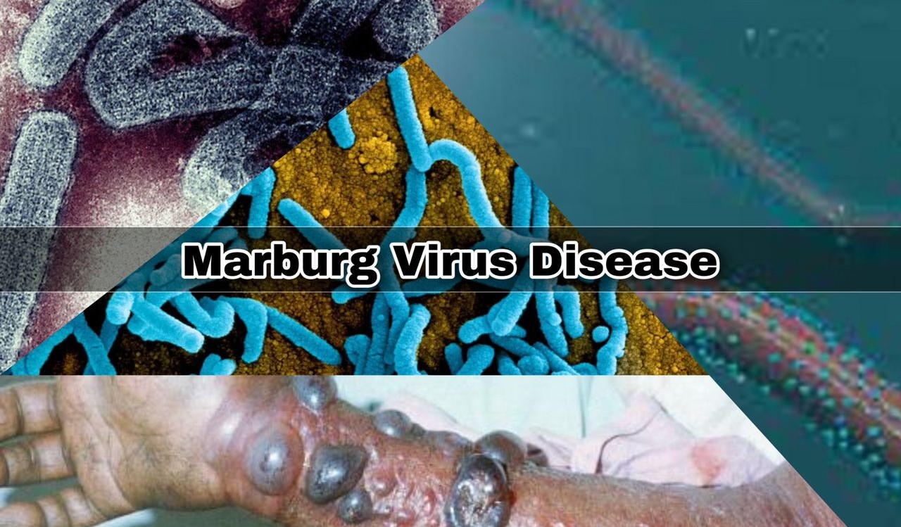 Marburg – Surto de vírus mortal na Etiópia acende alerta no mundo todo - Juranda News