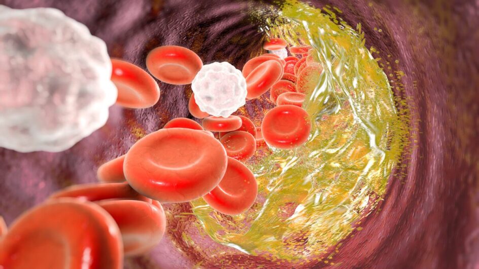 O risco da Lipoproteína