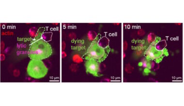 Cérebros Sob Ataque: Nova Estratégia com Células Personalizadas Mostra Eficácia Contra Glioblastoma