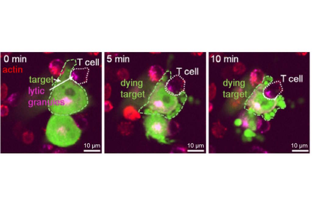 Cérebros Sob Ataque: Nova Estratégia com Células Personalizadas Mostra Eficácia Contra Glioblastoma