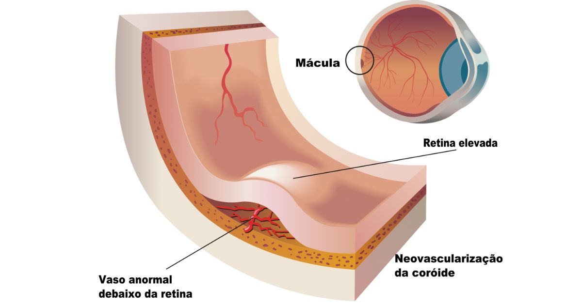A degeneração macular relacionada à idade ocorre quando células da mácula se deterioram, comprometendo a visão central