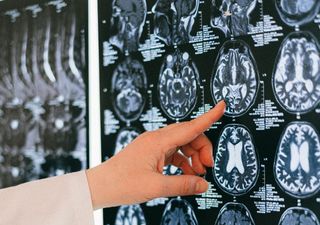 Médicos celebram o êxito do tratamento da doença de Huntington pela primeira vez