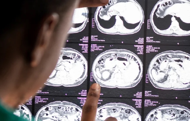 Especialista esclarece avanços e limites da IA no diagnóstico de AVC