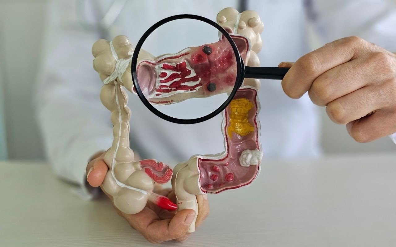 A ciência é clara: eliminar esse alimento pode reduzir drasticamente o risco de câncer, principalmente o câncer de cólon