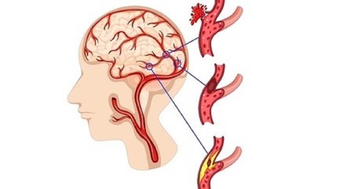 Pacientes com AVC precisam ser socorridos rapidamente
