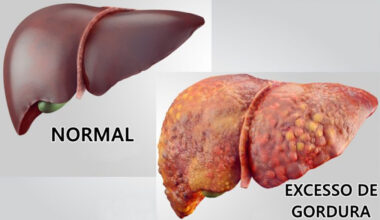 Mudar hábitos pode prevenir até 60% dos casos de câncer de fígado