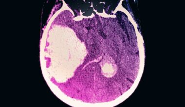 Consumo excessivo de álcool associado a hemorragias cerebrais mais mortais
