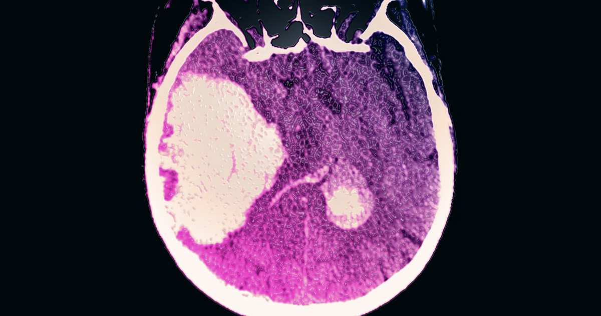 Consumo excessivo de álcool associado a hemorragias cerebrais mais mortais
