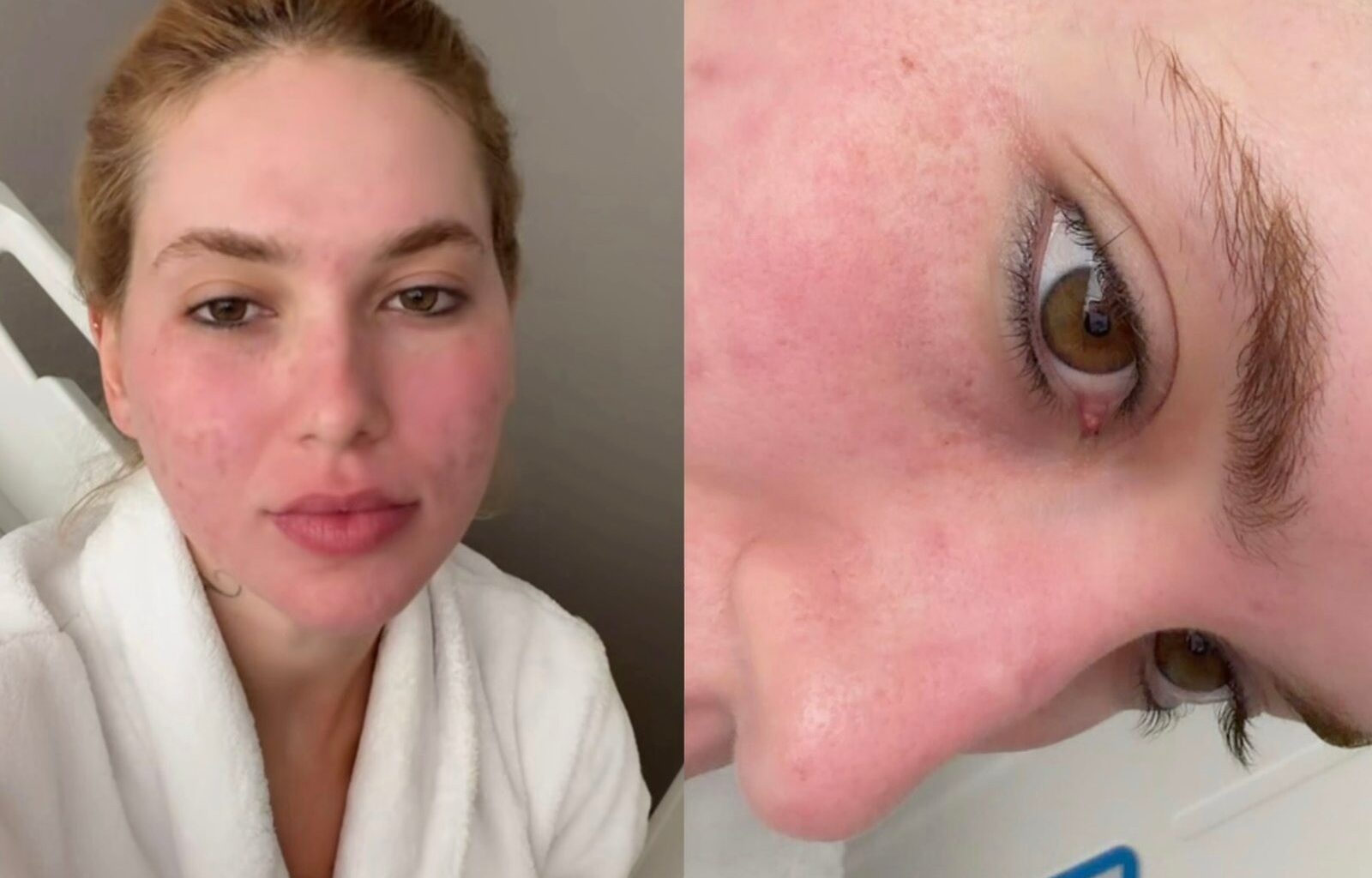 entenda o que é o laser de CO₂ profundo, tratamento feito pela influenciadora