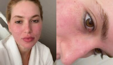 entenda o que é o laser de CO₂ profundo, tratamento feito pela influenciadora