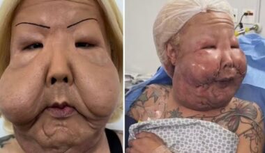 Influenciadora Juju do Pix passará por nova cirurgia para retirar óleo mineral do rosto