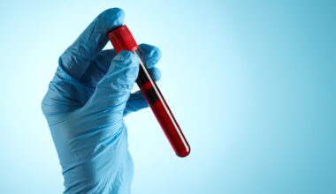 Teste de sangue pode detetar várias doenças 10 anos antes dos sintomas