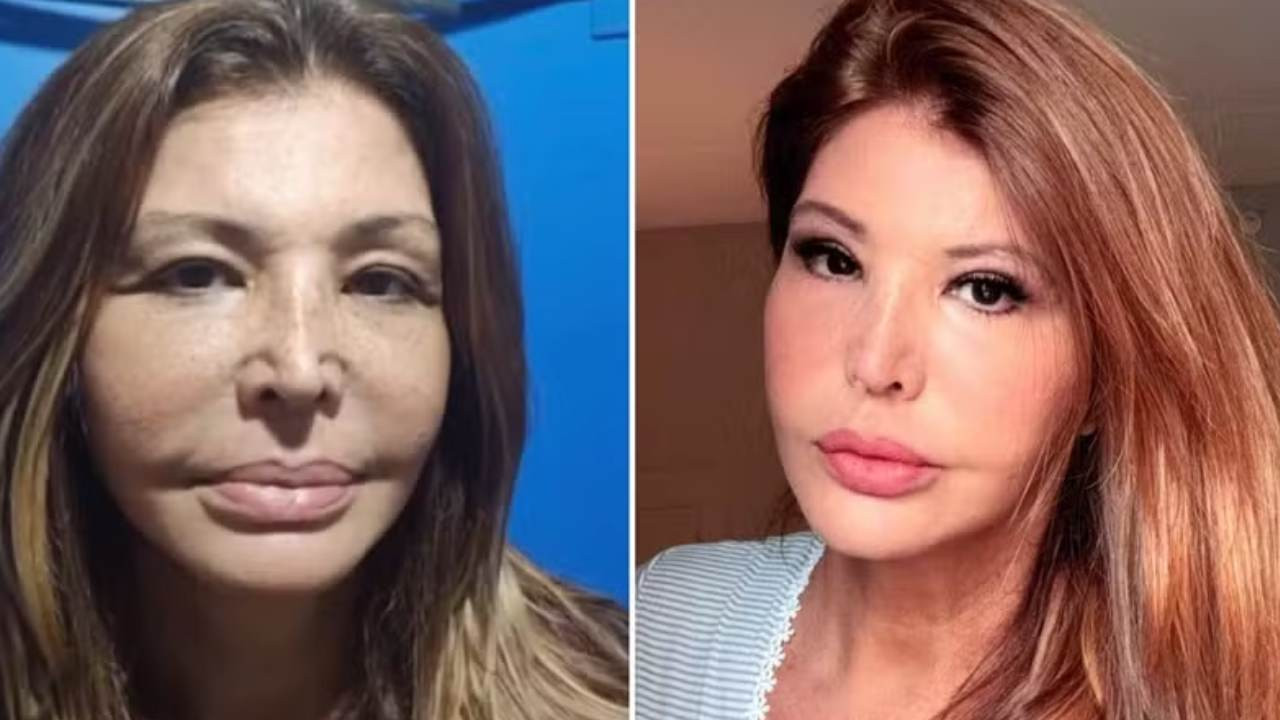 Aos 60 anos, Roberta Close se rende à harmonização facial