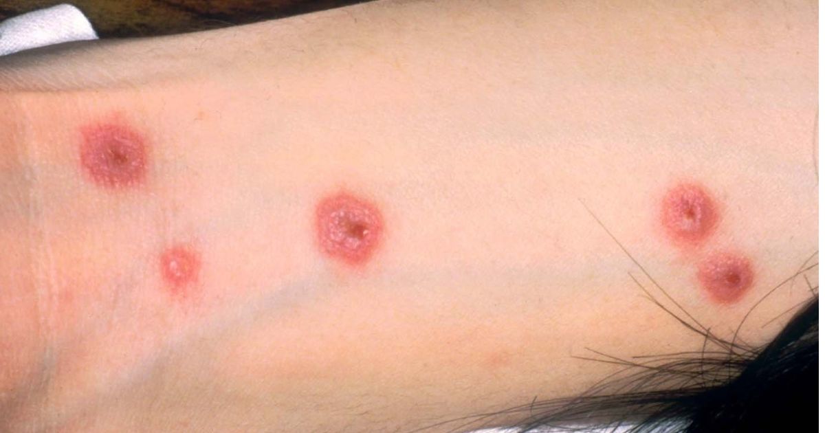 Síndrome rara provoca lesões na pele