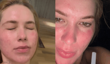 Virginia Fonseca mostra rosto após procedimento estético