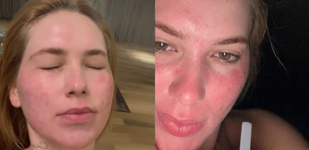 Virginia Fonseca mostra rosto após procedimento estético