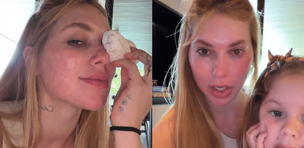 Virginia Fonseca mostra machucado nos olhos