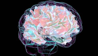 Tratamento personalizado? Descobertos dois novos subtipos de esclerose múltipla