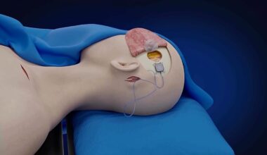 China: homem paralisado controla aparelhos com a mente apenas cinco dias após implante cerebral