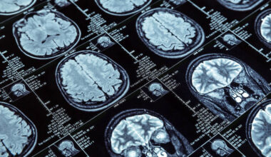 Células-tronco ajudam na recuperação após um derrame - 04/12/2025 - Equilíbrio e Saúde