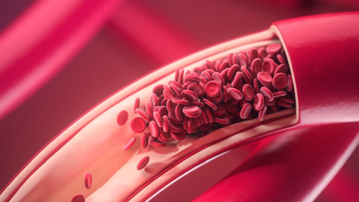 Como o calor e as viagens podem aumentar o risco de trombose no fim de ano