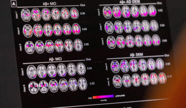 O que exames de sangue para detectar Alzheimer podem dizer - 19/12/2025 - Saúde