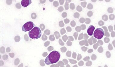 Células linfoblásticas T da leucemia aguda na medula óssea: poucas opções quando o tratamento principal falha  -  (crédito: WikimediaCommons/Divulgação )