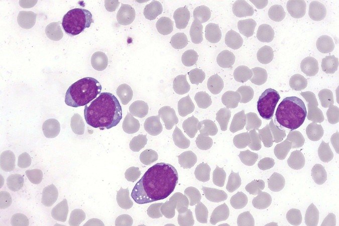 Células linfoblásticas T da leucemia aguda na medula óssea: poucas opções quando o tratamento principal falha  -  (crédito: WikimediaCommons/Divulgação )