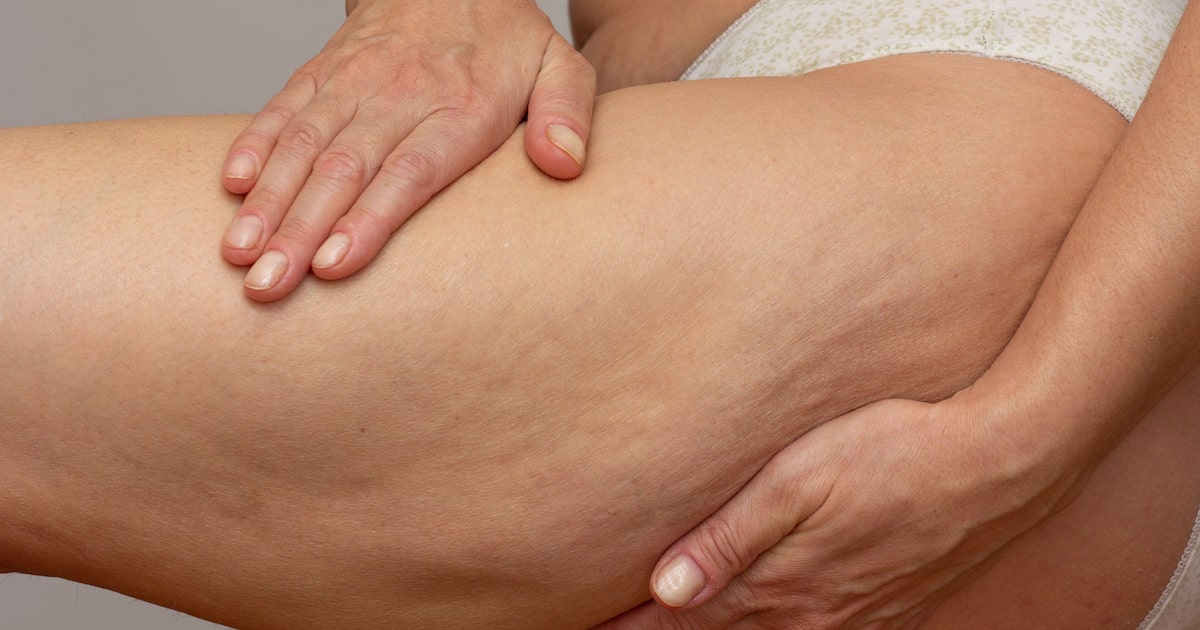 Novo estudo define critérios para diagnóstico por imagem do lipedema, que aflige 12% das brasileiras