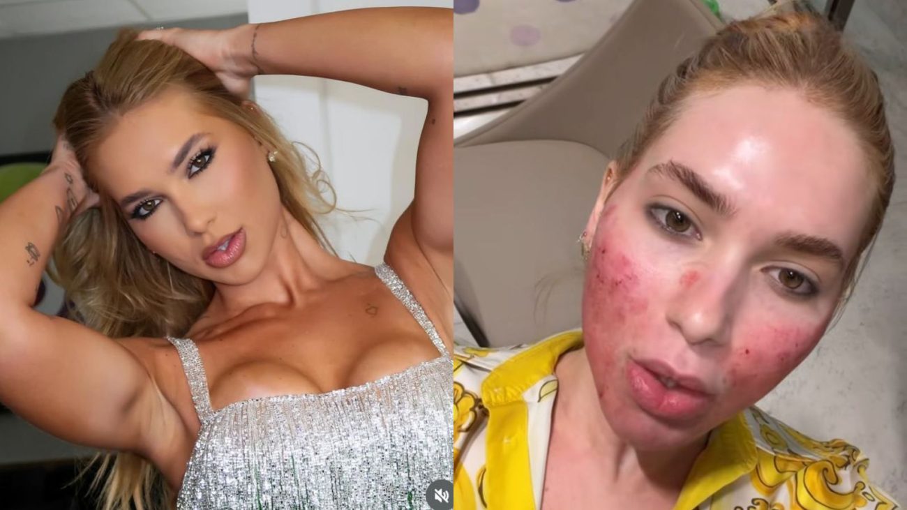 Imagem mostra um comparativo de fotos da Virginia Fonseca antes e depois do procedimento estético no rosto. 