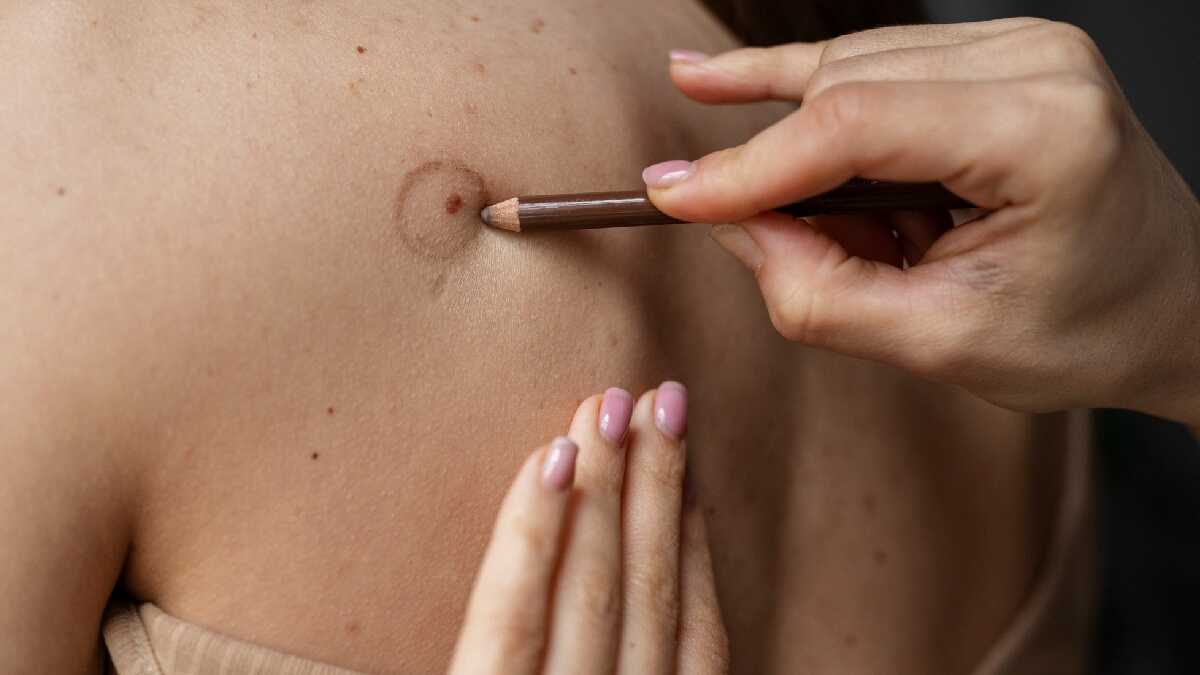 Câncer de pele: confira orientações, sintomas e mitos sobre a doença