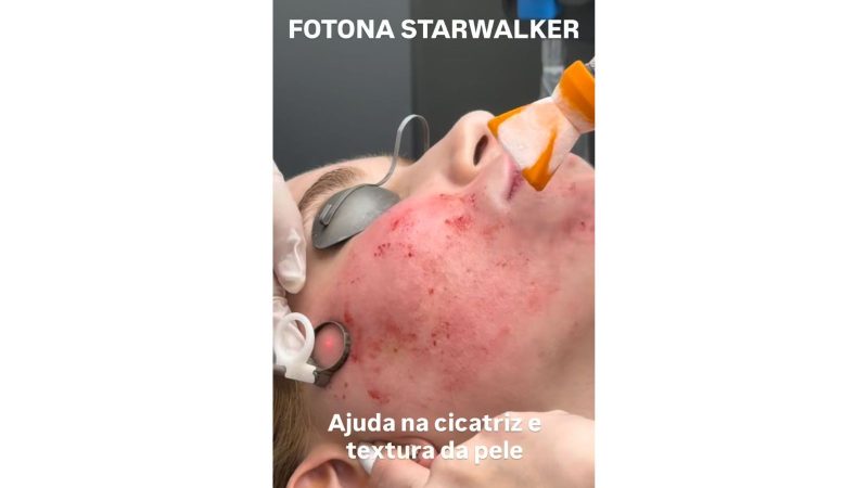 O Fotona Starwalker. - Virginia Fonseca/@virginia/Instagram