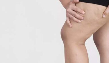 Novo estudo define os critérios para diagnóstico por imagem do lipedema, que aflige brasileiras