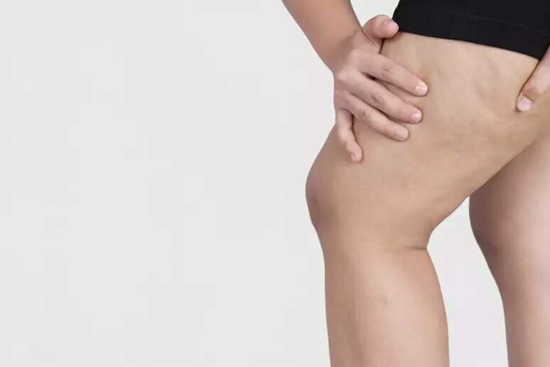 Novo estudo define os critérios para diagnóstico por imagem do lipedema, que aflige brasileiras
