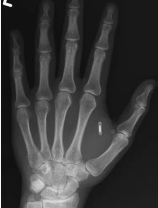 Imagem partilhada pelo mágico Zi Teng Wang, que atua sob o nome artístico Zi the Mentalist. O raio-X mostra um chip RFID entre o polegar e o indicador da mão.