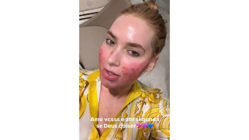 Pelas imagens, o rosto de Virginia aparece bastante vermelho. - Virginia Fonseca/@virginia/Instagram