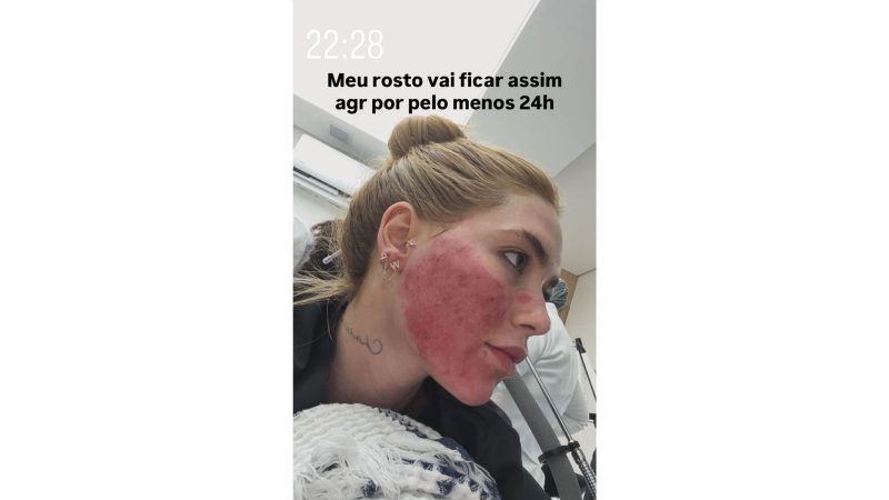 A influenciadora mostrou como ficou o rosto pós-procedimento. - Virginia Fonseca/@virginia/Instagram