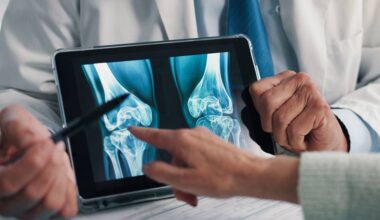 Casos de osteoporose devem disparar até 2050, inclusive no Brasil