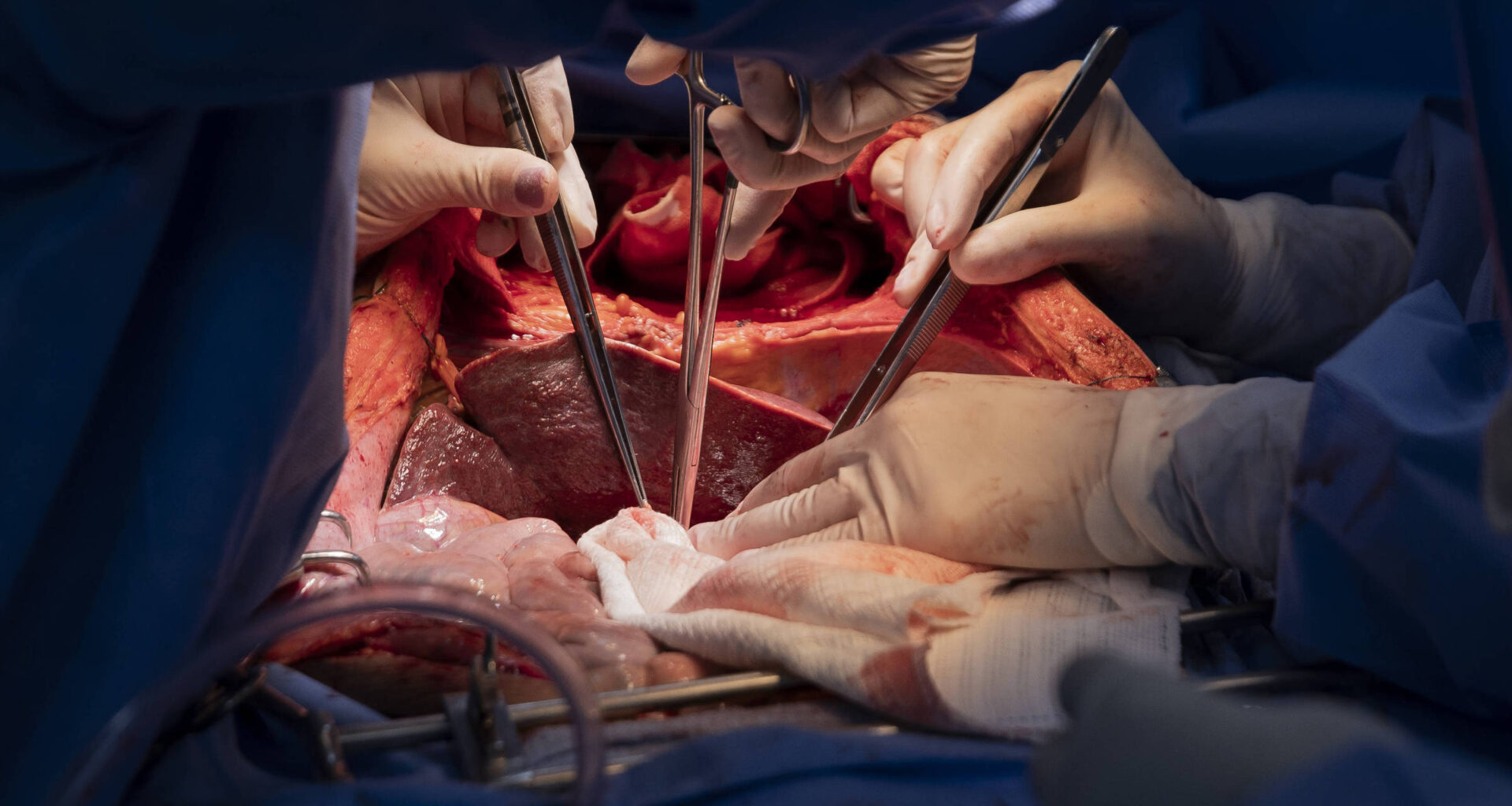 Droga pode melhorar qualidade de rins para transplante - 07/01/2026 - Equilíbrio e Saúde