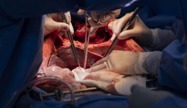 Droga pode melhorar qualidade de rins para transplante - 07/01/2026 - Equilíbrio e Saúde