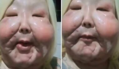 Juju do Pix enfrenta problema em cicatriz após cirurgia para remover óleo mineral do rosto